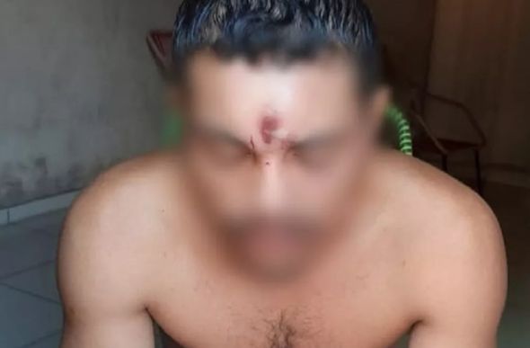 Homem levou tiro na testa e sobreviveu em Araguaína — Foto: Reprodução/Redes sociais
