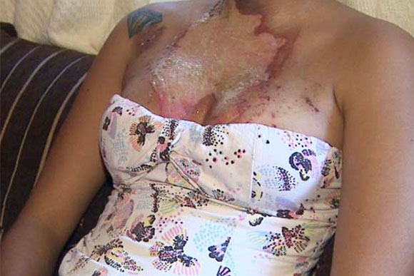 Mulher é levada para a Santa Casa de Poços de Caldas com queimaduras graves / Foto Ilustrativa: cbnfoz.com.br